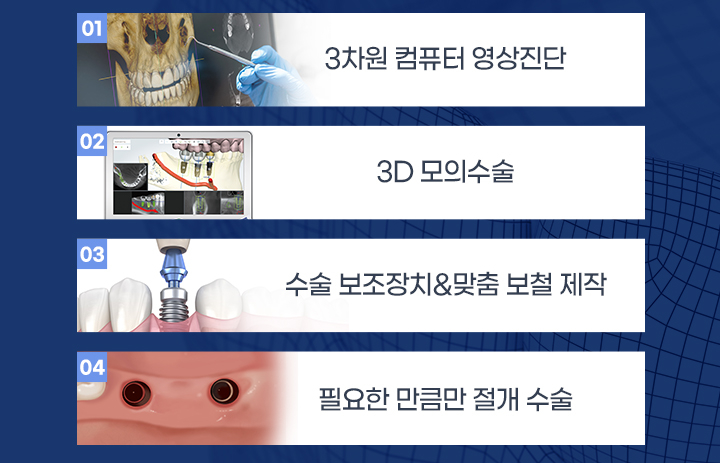 구로치과 오차는 줄이고, 성공률은 높인 임플란트